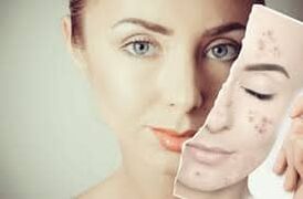 A Botox cseréje