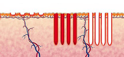Hogyan működik a frakcionált lézer