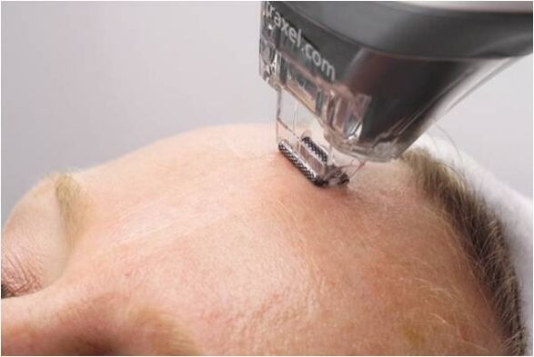 peeling eljárás az arcbőr megfiatalítására